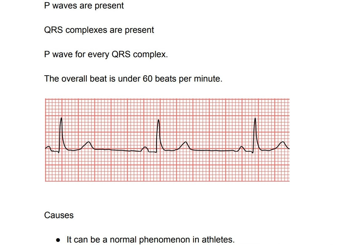 Understanding EKGs Guide